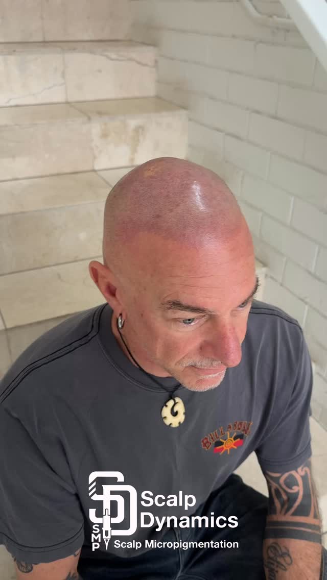 Recent Scalp Dynamics treatment 11