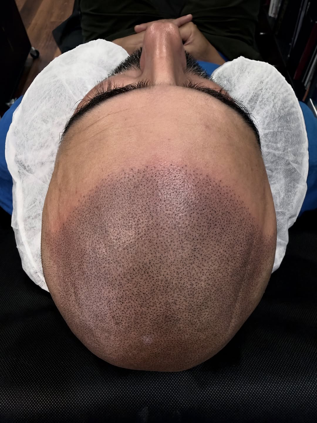 Recent Scalp Dynamics treatment 3