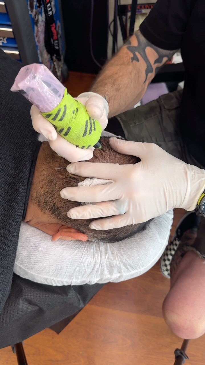 Recent Scalp Dynamics treatment 1